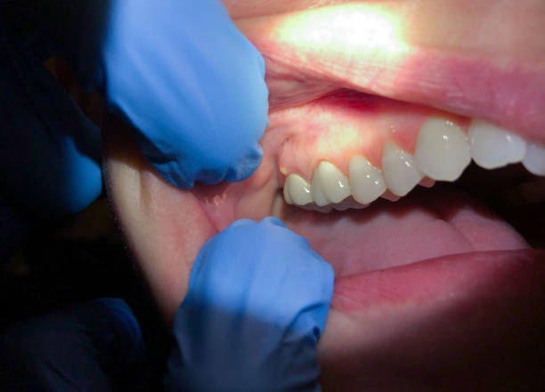Best Cracked Tooth Emergency Dentist  in Carlisle, KY