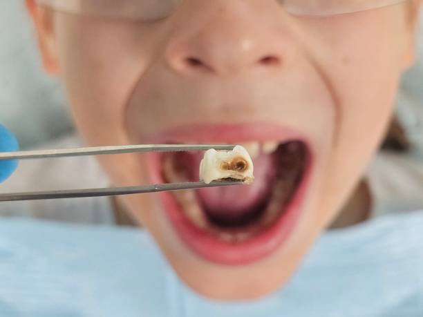 Best Chipped Tooth Repair Near Me  in Carlisle, KY